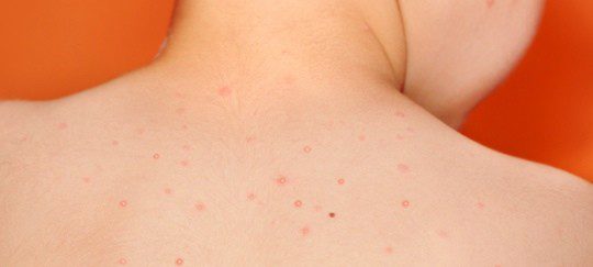 Esta enfermedad contagiosa puede crear úlceras de piel