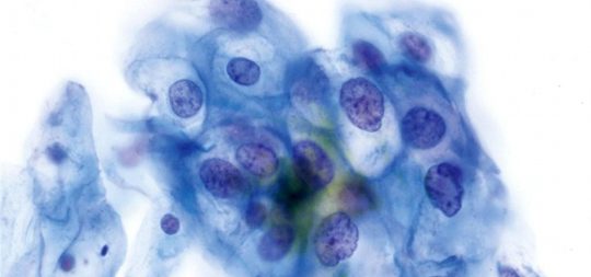 Citología de una lesión provocada por el Virus del papiloma Humano