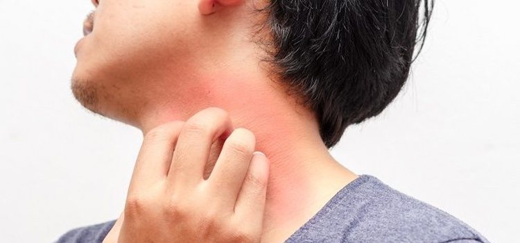 El principal síntoma de la alergia al látex es la urticaria